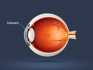 Excessive sunlight exposure may lead to ultraviolet damage to the lens causing a cataract.